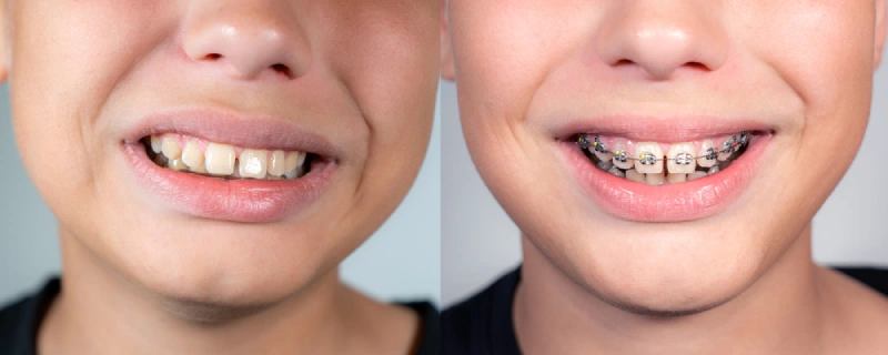 Side-by-side image of a child with an overbite and a child wearing braces to fix an overbite