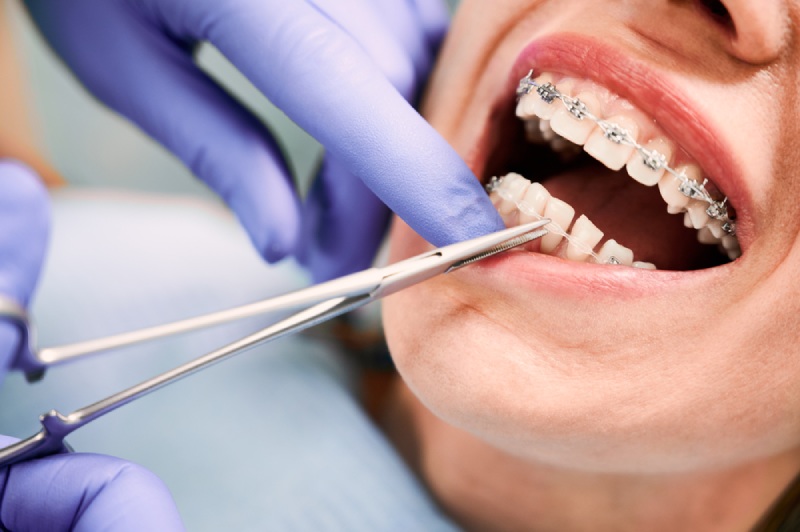 Orthodontist installing braces