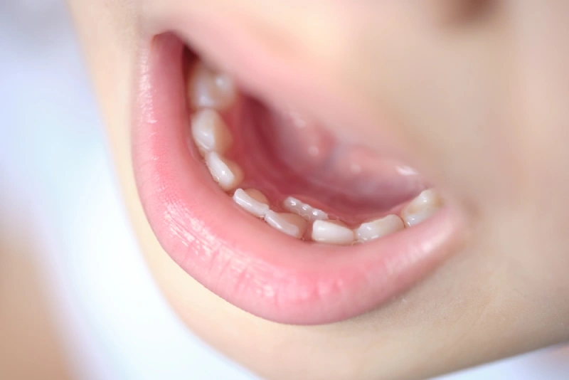 Young boy with “shark teeth” on the bottom row of teeth