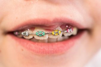 Multicolor braces brackets