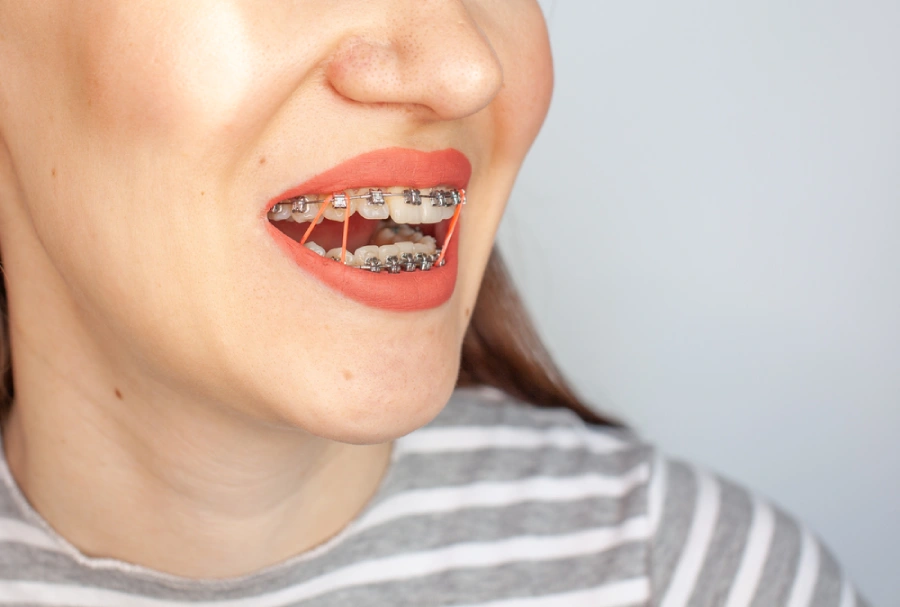 Braces elastics used to help correct an overbite