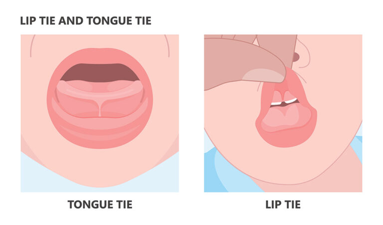 Lip tie and tongue tie in a baby’s mouth