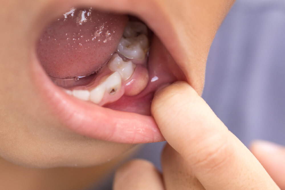 Tooth decay in child’s mouth 