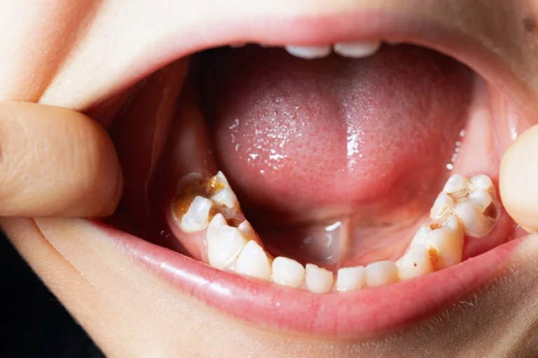 Childs mouth with tooth decay