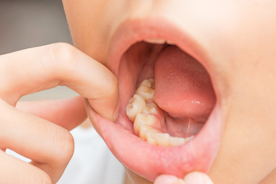 A child shows off what happens with untreated overcrowded teeth with what is known as a malocclusion.