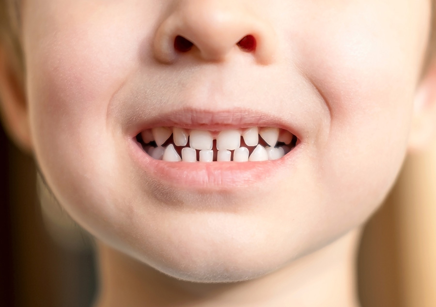 A close up view of a young boy’s mouth with his baby teeth