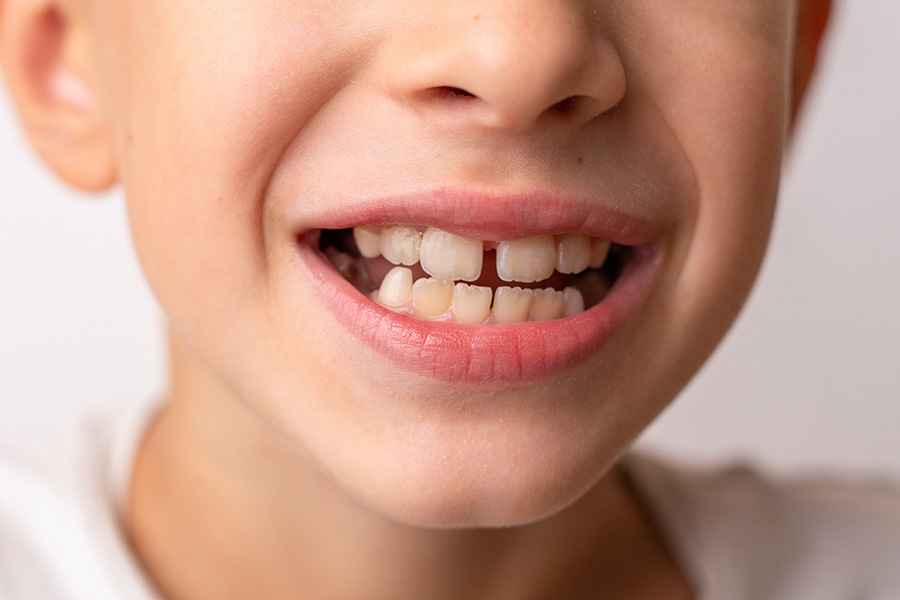 Closeup of young boy’s face highlighting a prominent gap between the two front top teeth