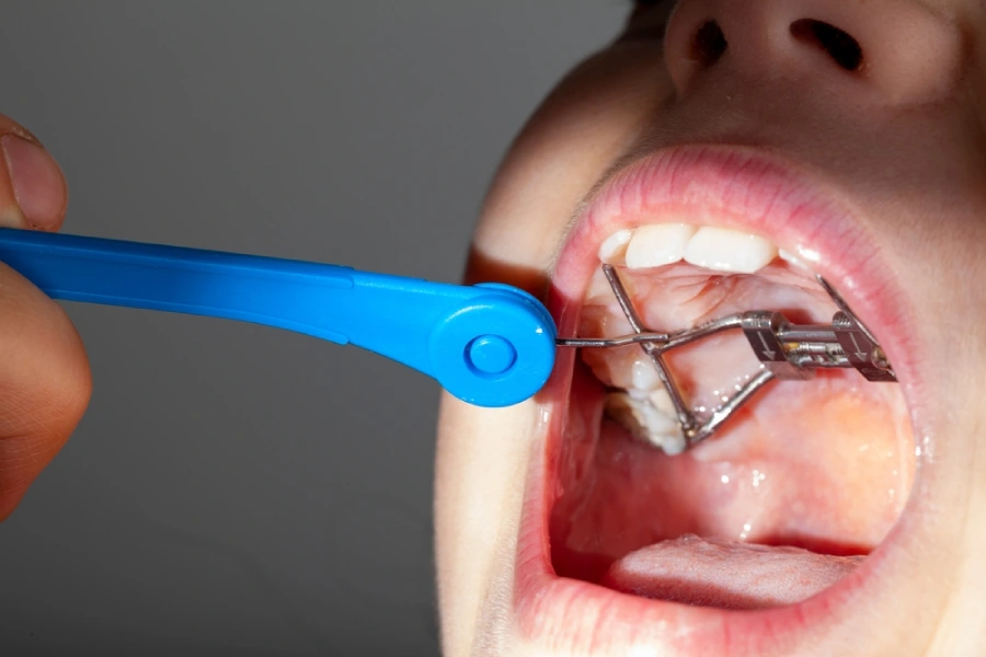 Dentist uses blue probe to examine young caucasian female’s palate expander