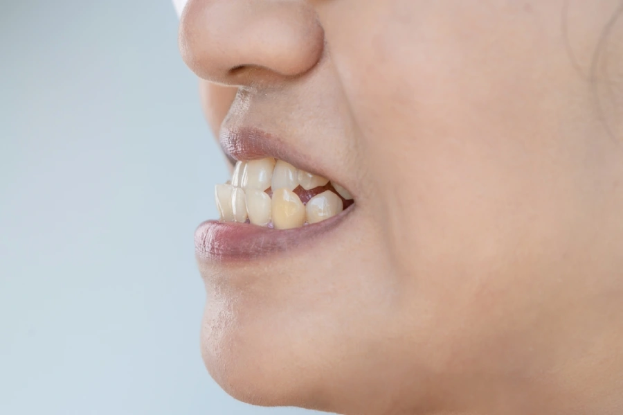 Close-up side profile of a mixed-race young woman with an underbite